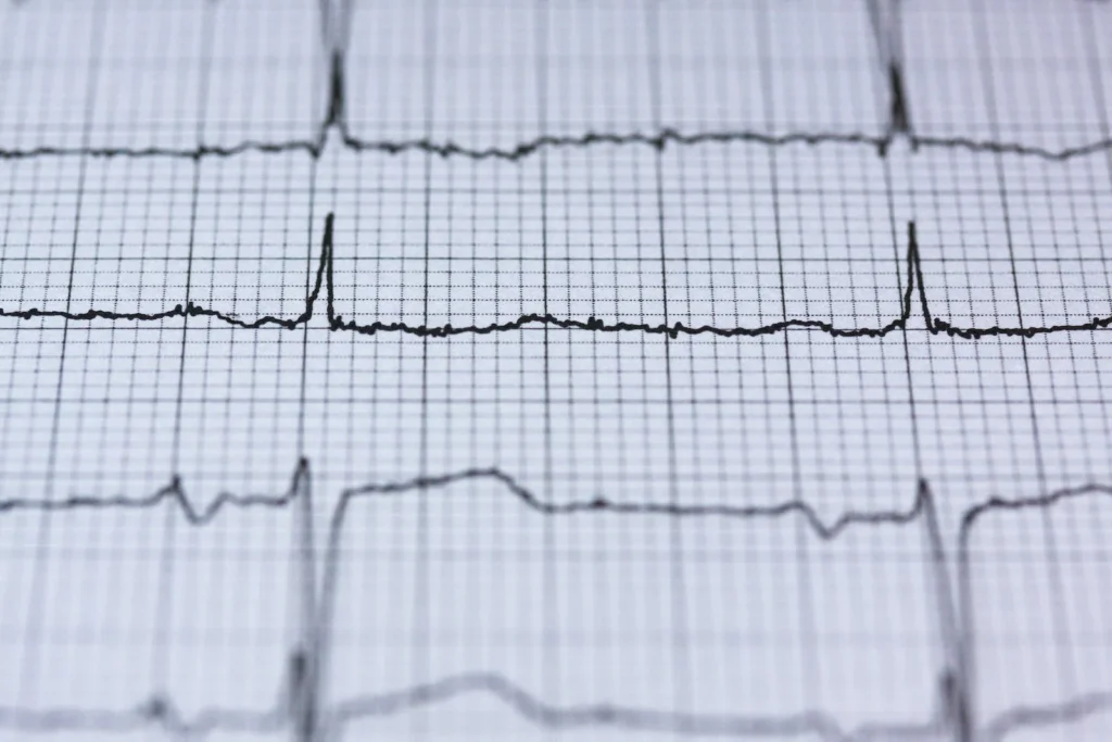 Um eletrocardiograma pode ajudar a detectar um problema de coração no início. Por isso não consultar só quando sente dor.