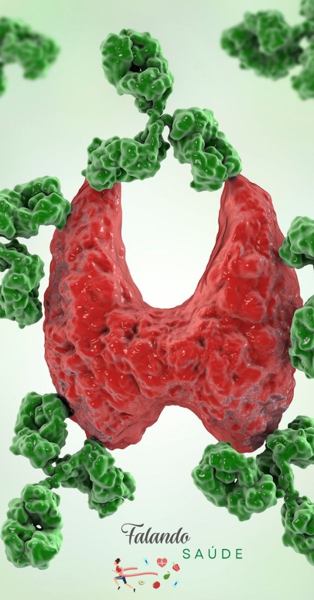 "Tireoidite de Hashimoto com hormônios normais. Ilustração da glândula tireoide com função normal na Tireoidite de Hashimoto"